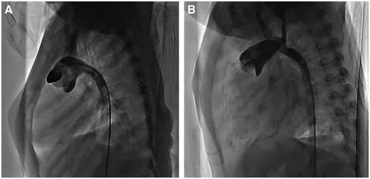 Angiogram of the aorta after the Norwood operation. (A) Conventional Norwood procedure; (B) pulmonary artery trunk-saving procedure.
