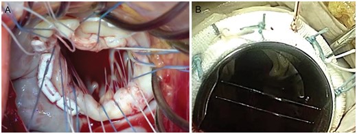 Intraoperative left atrial view of the mitral annulus before (A) and after (B) the insertion of the On-X prosthesis with complete preservation of the mitral valve apparatus.