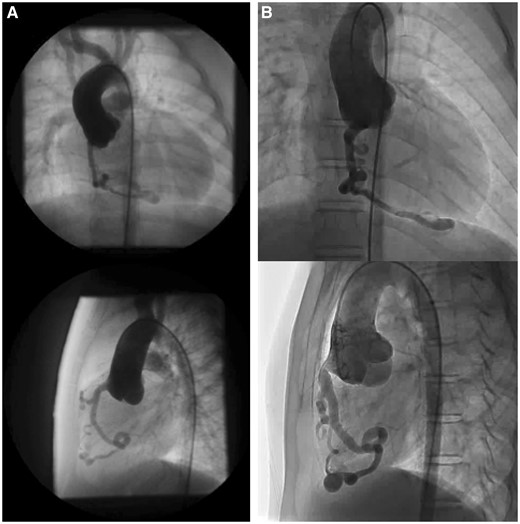 Coronary artery dilatation and meandering. Coronary angiograms (top row: frontal view; bottom row: lateral view) before the Fontan operation (A) and 10 years after the Fontan operation (B).