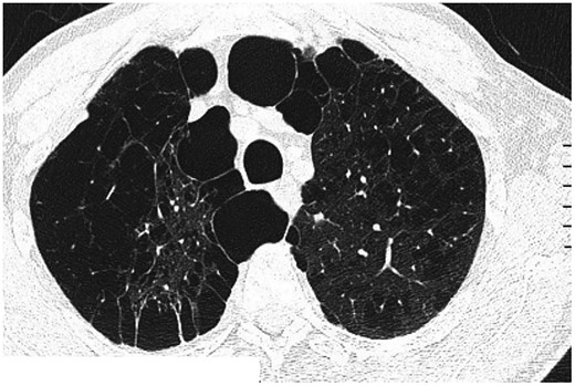 Computed tomography findings of centrilobular and bullous emphysema.
