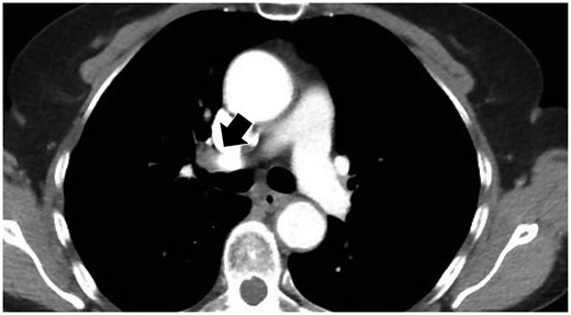 Computed tomography findings of visible hilar lymph nodes located along the main-stem bronchi (black arrow).