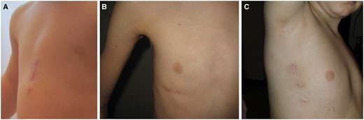 Postoperative images (1 month after surgery) showing the different minimally invasive surgical approaches used for ostium secundum atrial septal defect closure in our institution. (A) Ministernotomy; (B) right anterior minithoracotomy; and (C) right lateral minithoracotomy.