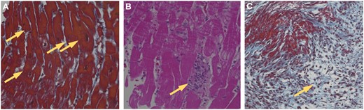 Histological evaluation of ischaemic reperfusion injury using endomyocardial biopsy samples of the right ventricle. Specific pathological findings of IRI include (A) coagulative myocyte necrosis (yellow arrows), (B) polymorphonuclear inflammation (yellow arrow) and (C) de novo fibrosis (yellow arrow).