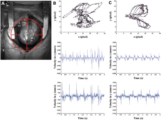 Video kinematic results obtained pre- and post-pulmonary valve replacement (PVR). (A) Marker position (red circle) on the patient’s heart (RV) during open-chest surgery. (B) Upper panel, marker trajectories (black lines with ticks) and acceleration (pink arrows) pre-PVR. Middle panel, video cardiogram in x-axis pre-PVR. Lower panel, video cardiogram in y-axis pre-PVR. (C) Same as (B) but post-PVR. AAo: ascending aorta; Black dashed circle: effective area of analysis; RA: right atrium; RV: right ventricle.