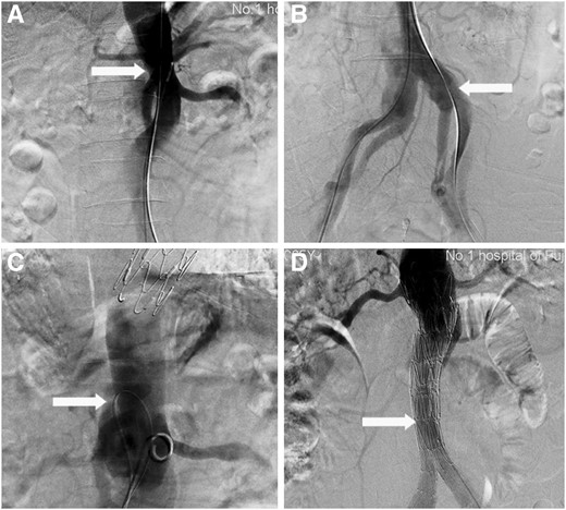 Septectomy using an intrinsic visceral entry, featured with confined cutting range. (A) Access of the visceral entry (write arrow) is completed. (B) The 0.014’ wire is captured by the snare and pulled out via the most distal entry (write arrow) and thereby establishing a through-and-through wire access. (C) The septum is cut using a Gigli saw (write arrow). (D) Endovascular aneurysm repair (write arrow) is performed using the landing zone at the post-cut abdominal aortic segment below the level of the renal artery.
