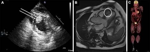 Preoperative (A) trans-thoracic echocardiogram showing a heterogeneous, hyperechoic mass (double arrows) in the mid-to-apical ventricular septum that is embedded in the myocardium, (B) cardiac magnetic resonance imaging showing a 3.2 cm × 1.6 cm ventricular septal mass (white circle) extending from the mid-to-apical septum and (C) preoperative positron emission tomography scan showing no evidence of uptake anywhere in the body.