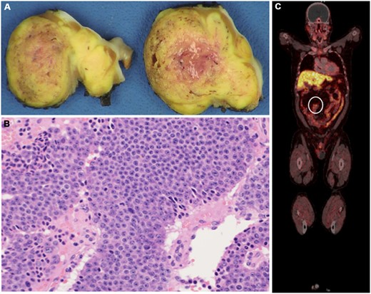 (A) Cut section of the resected mass showing 3.9 cm × 2.5 cm × 1.8 cm, partially encapsulated, yellow-tan mass and (B) histopathological examination of the resected mass showing epithelioid cells arranged in nested and organoid patterns, with eosinophilic secretions. The tumour cells had moderate amounts of eosinophilic cytoplasm and stippled chromatin; there were up to 5 mitotic figures/mm2. The Ki-67 proliferative index was up to 10%, with no necrosis. (C) Follow-up positron emission tomography scan with Gallium-68 dotatate showing the increased uptake in the small bowel and mesenteric lymph nodes (circle). These are specific for neuroendocrine tumours.