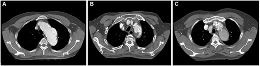 (A–C) Preoperative computed tomography scans of 3 patients with type Ia endoleak.