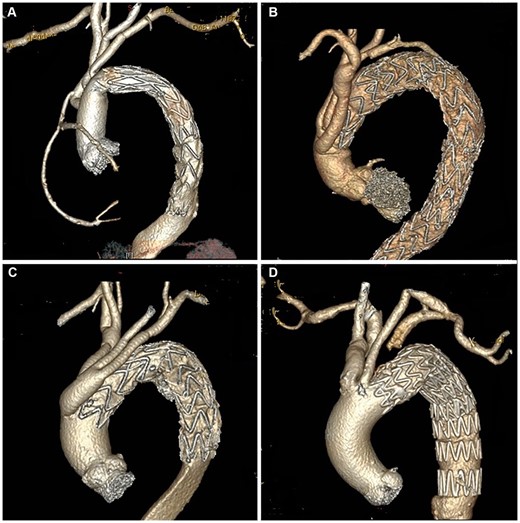Postoperative computed tomography scans of patients treated with 4 different techniques. (A) Total arch replacement with the frozen elephant trunk technique; (B) hybrid aortic arch repair; (C) arch debranching with thoracic endovascular aortic repair (TEVAR); and (D) left subclavian artery–left common carotid artery bypass with TEVAR.
