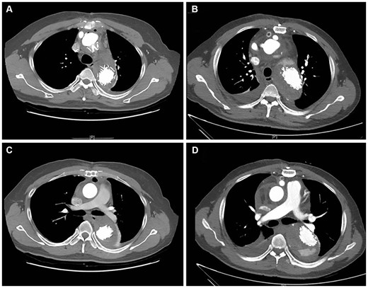 Postoperative complete thrombosis and partial thrombosis of the false lumen on computed tomography scans. (A) Complete thrombosis at the proximal part of the stent; (B) partial thrombosis at the proximal part of the stent; (C) complete thrombosis at the distal part of the stent; and (D) partial thrombosis at the distal part of the stent.