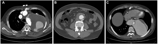 Computed tomography (CT) scans of 3 patients with aortic events. (A) The last CT scan shows a progressively enlarged false lumen; the patient died of ruptured aortic dissection 45 months after the CT examination. (B) CT scan obtained before the operation shows an abdominal aortic aneurysm (diameter = 53 mm); the patient died of a ruptured abdominal aortic aneurysm 12 months after the operation. (C) The CT scan shows progressive dilatation of the false lumen; the patient had a secondary thoraco-abdominal aortic aneurysm repair 4 months after the initial operation.