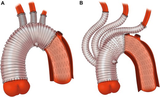 Surgical details of total arch replacement with frozen elephant trunk and hybrid type II arch repair. (A) In total arch replacement with frozen elephant trunk group, aortic arch was transected between the left carotid artery and left subclavian artery and replaced by a four-branched prosthetic graft with the frozen elephant trunk implanted into the descending aorta. (B) In hybrid type II arch repair group, aortic arch was cross cut between the innominate artery and left carotid artery, and ascending aorta was replaced with a four-branched prosthetic graft whose trunk served as the proximal landing zone for the stent graft.