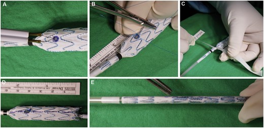 Custom-made iliac bifurcation device table procedure (A–E). (A) Fenestration hole creation. (B) 014″ wire reinforcement. (C) Tape-assisted reloading. (D) Alignment mark for reloading. (E) Complete reloading.