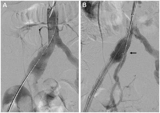 Custom-made iliac bifurcation device deployment under fluorescence (A, B). (A) Aneurysm length measurement. (B) Custom-made iliac bifurcation device deployment and internal iliac artery stent grafting by axillary cannulation.