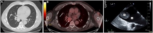 Non-contrast computerized tomographic (A) and positron emission tomographic (B) scans demonstrating the middle lobe nodule (solid arrow) and lower lobe mass (broken arrow). Two-dimensional transoesophageal echocardiogram (C) demonstrating the tumour mass in the left atrium.