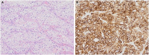 Histological examination of the tumour by haematoxylin and eosin stain (A) and renal cell carcinoma immunohistochemistry showing strong positive staining of the tumour cells (B). Magnification ×200.