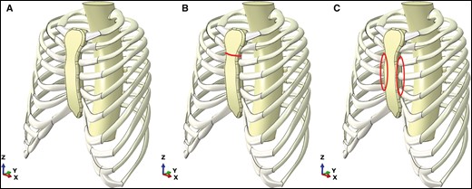 The 3 different cases for the 4.8 Haller index model, showing in red the sternal osteotomy or the chondrotomies. (A) Pectus excavatum, (B) pectus excavatum with transverse sternotomy and (C) pectus excavatum with costal chondrotomies.