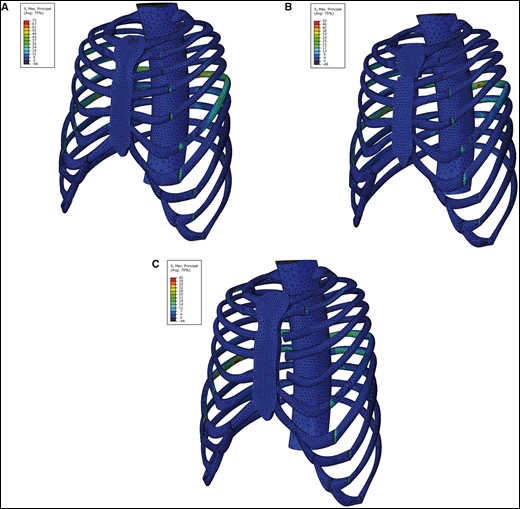 Stress distribution (MPa) in the rib cage after corrective surgery. (A) Pectus excavatum model, (B) pectus excavatum with transverse sternotomy model and (C) pectus excavatum with costal chondrotomies model.
