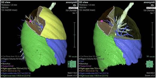 Virtual simulation of segmentectomy.