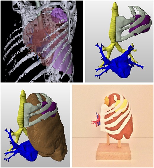3D reconstruction, processing (STL file) and 3D print of the tumour left upper lobe with thoracic wall invasion.