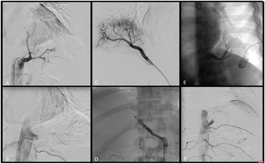 (A) Case 1: Transcatheter arterial angiography shows the aberrant branch supplying the left lower lobe originating from the thoracic aorta. (B) Case 1: The anomalous artery branch was catheterized with a guiding catheter, and it was then embolized by positioning an Amplatzer vascular plug type II, 12 mm. (C) Case 2: Transcatheter arterial angiography shows the aberrant branch supplying the right lower lobe originating from the coeliac trunk. (D) Case 2: The aberrant branch was successful embolized with an Amplatzer plug. (E) Case 3: Transcatheter arterial angiography shows the aberrant branch supplying the left lower lobe originating from the thoracic aorta. (F) Case 3: Endovascular embolization of the anomalous arterial branch of the descending thoracic aorta.