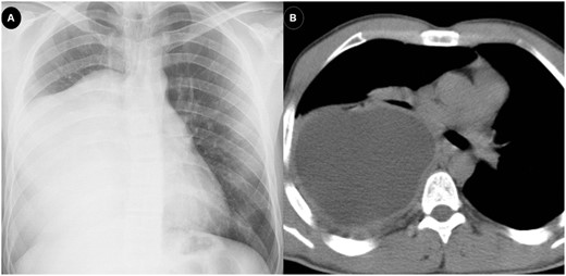 Posteroanterior chest X-ray (A) and axial thorax computed tomography scan (B) of a 22-year-old male patient who had a giant hydatid cyst of ∼44 mm × 123 mm × 185 mm in the right lower lobe and recurred later.