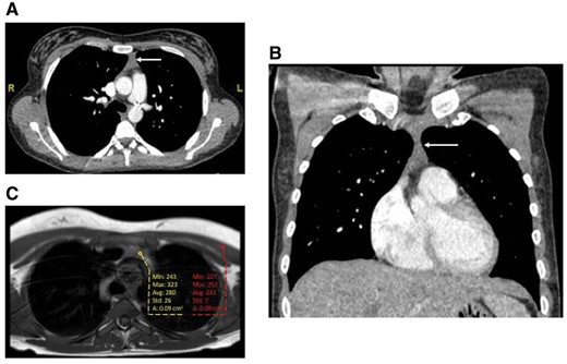Computerized tomographic scan demonstrating anterior mediastinal soft tissue (arrow) in the (A) axial and (B) coronal planes. Axial T1W spin-echo magnetic resonance imaging scan (C) demonstrating anterior mediastinal soft tissue mildly hyperintense (yellow) compared to skeletal muscle control (red).