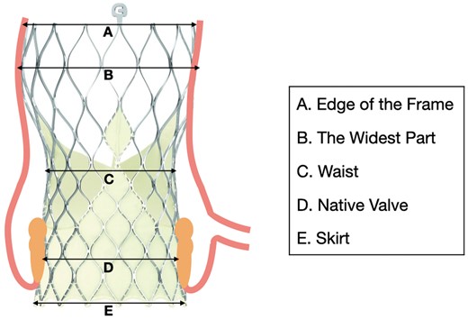 Structure of the CoreValve Evolut R. (A) Edge of the frame. (B) The widest part. (C) Waist. (D) Crushed native valve. (E) Skirt.