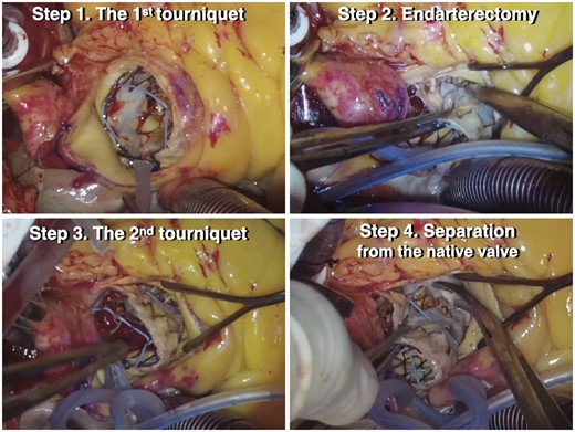 The lasso technique for explanting a prosthesis with a self-expanding frame. Step 1: Purse-string suture at the distal edge of the frame and fastening using a tourniquet. Step 2: Endarterectomy between the frame and the aortic wall. Step 3: A second purse-string suture at the widest part of the frame and fastening using a tourniquet. Step 4: Separation of the device from the native aortic valve.