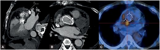 (A, B) Oblique and axial planes of the thoracic computed tomography angiogram revealing a protrusion from the aortic wall continuous with the vessel lumen, adjacent to the superior border of the prosthesis. (C) Positron emission tomography summary graphic showing avid fluorodeoxyglucose uptake on the topography of the pseudoaneurysm.
