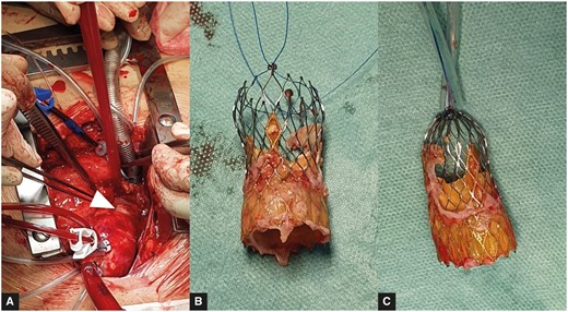 (A) Arrowhead points to the protrusion from the aortic wall. (B, C) Side-by-side comparison of the CoreValve™ after explantation, before and after tying the snuggers passed through the upper holes of its mesh.