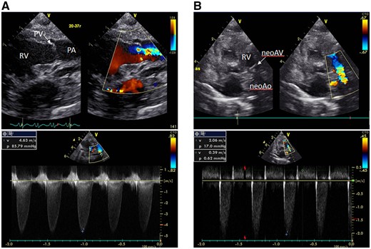(A) A transthoracic echocardiogram after birth reveals a severely stenotic pulmonary valve with 3 dysplastic and thickened leaflets with a peak pressure gradient of 86 mmHg across the pulmonary valve. (B) Postoperative echocardiography shows a pressure gradient of 17 mmHg across the neoaortic valve, with an improved neoaortic valve regurgitation. neoAo: neoaorta; neoAV: neoaortic valve; PA: pulmonary artery; PV: pulmonary valve ; RV: right ventricle.