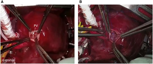 (A) The pulmonary valve as shown during the Norwood procedure. Three thickened and dysplastic leaflets make the orifice opening limited. (B) Neoaortic valve leaflet replacement using glutaraldehyde-treated autologous pericardium. The new 3 pericardial leaflets are sutured to each annulus. PV: pulmonary valve.
