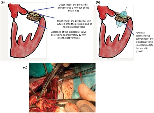 Intraoperative view (a) Biopulmonic Valve in Mitral position, (b) Potential ballooning, (c) intraoperative field.