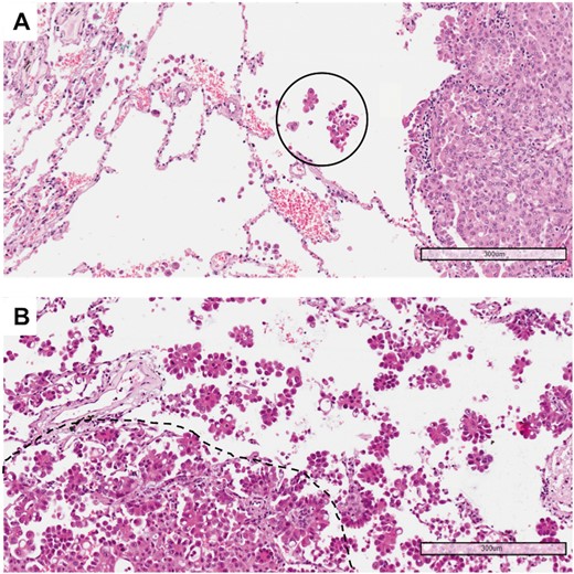 (A) Example of a tumour with low spread through air spaces: only 1 solid nest of neoplastic cells (circle) is detectable in the alveolar spaces beyond the edge of the tumour (haematoxylin and eosin, 10×). (B) Example of a tumour with high spread through air spaces: multiple micropapillary clusters are present beyond the edge of the tumour (dashed line) (haematoxylin and eosin, 10×).