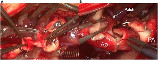 (A) Aortic intramural course of the LCA. (B) Anastomosis between LCA and aorta after patch plasty on the inferior surface of the LCA with native autologous pericardium. Ao: aorta; LCA: left coronary artery; PA: pulmonary artery.