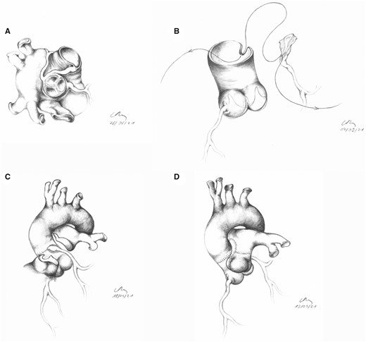(A) Aortic intramural course of the left coronary artery (LCA). (B) Anastomosis between LCA and aorta after patch plasty of the proximal LCA. The patch had to be inserted on the “intramural” part of the coronary artery wall, in this case, inferiorly. (C) Completed neo-ostium of the LCA. (D) Reconstruction of the pulmonary artery with autologous native pericardial patch.