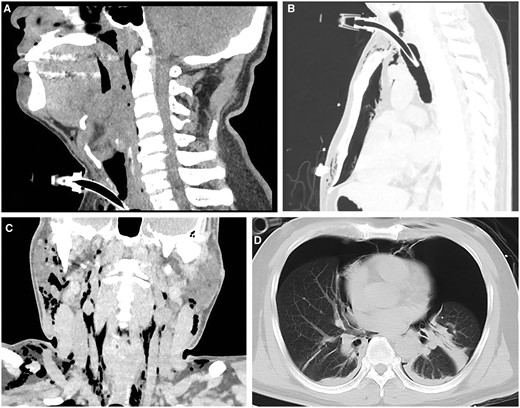 (a) Coronal high-resolution computed tomography image of the neck shows that the upper airway (from the larynx to the site just above glottis) was completely blocked with a swollen epiglottis in between; (b) severe spontaneous pneumomediastinum; (c) a large-scale subcutaneous emphysema; and (d) pneumothorax.