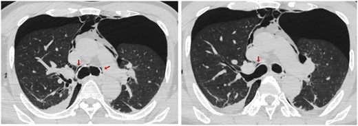 High-resolution computed tomography scan demonstrates air collected along the perivascular connective tissue, the Macklin effect (arrows), in the perihilar area, and pneumomediastinum and bilateral pneumothorax.