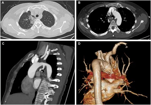 (A) Chest computed tomography. (B, C) Computed tomography angiography in axial and sagittal views. (D) Reconstructed three-dimensional computed tomography angiography. Arrow demonstrates (i) flake ground-glass shadows in the right upper lobe. (ii) An aberrant artery arises from the aortic arch.