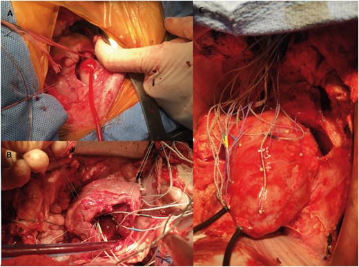 Intraoperative photographs of (A) pulmonary artery banding through a left thoracotomy, (B) implanted crystals around the tricuspid annulus and (C) sonomicrometry crystals on right ventricular epicardium with externalized right ventricular and left ventricular pressure transducers.