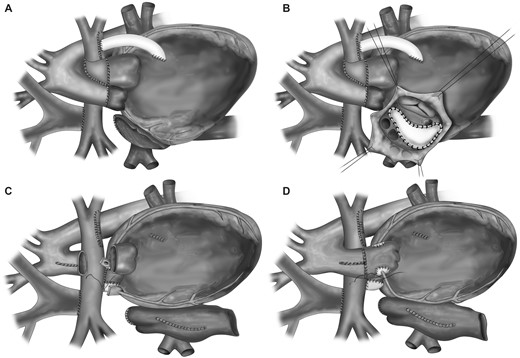 Surgical technique. (A) Initial status: Damus–Kaye–Stansel procedure and Glenn operation (pulmonary arteries connected to the Glenn anastomosis on the right, and to the Sano connection on the left). (B) Hemi-Mustard procedure without unroofing of the coronary sinus. (C) Neo-pulmonary artery reconstruction and removal of the coronary buttons. (D) Neoaorta reconstruction with coronary reimplantation and reduction of the ascending aorta.