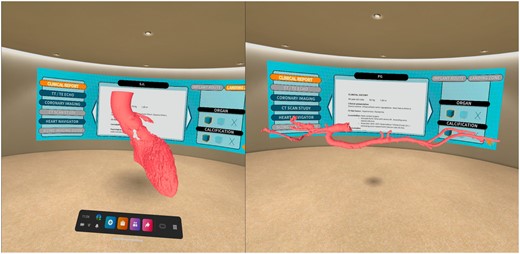 Virtual room platform with all the clinical and image information of the patient on a panel and virtualized tridimensional model of the access route and landing zone. We can ‘walk around and inside’ the model analysing all anatomical details, the pattern of calcification and coronary ostia location. In addition, there is availability of tools to turn, expand, measure, draw, segment and visualize specific parts of the anatomy by enabling the transparency of tissues or take a pictures/videos and save them to the computer.