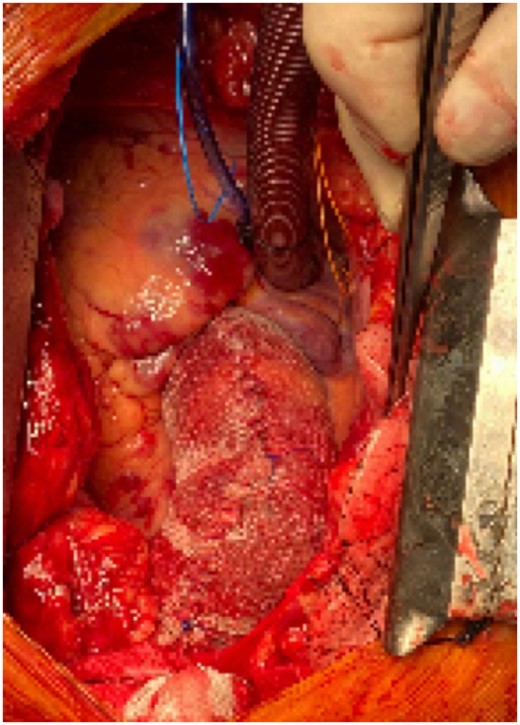 Intraoperative view of external wrapping with a polypropylene mesh graft and a reduction of the overall diameter by 5–10 mm.