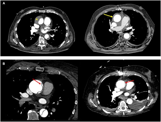 (A) Preoperative CT scan of the 87-year-old patient with an intramural haematoma of the ascending aorta (left) with a thickness of 22 mm (*) and postoperative control 3 months following wrapping (right): the intramural haematoma has practically completely disappeared (arrow) and the aortic diameter has remained stable. Retrospectively, it was suspected that the primary tear occurred in the proximal descending aorta and extended in a retrograde way up to the ascending aorta. (B) Preoperative CT scan in a 72-year-old female under oral anticoagulation demonstrating acute aortic dissection with the flap in the ascending aorta (left with red arrow) and postoperative control 12 months later (right) showing an almost disappearance of the dissecting membrane in the ascending aorta (red arrow) and absence of aortic growth, peri-aortic haematoma and/or pericardial effusion.