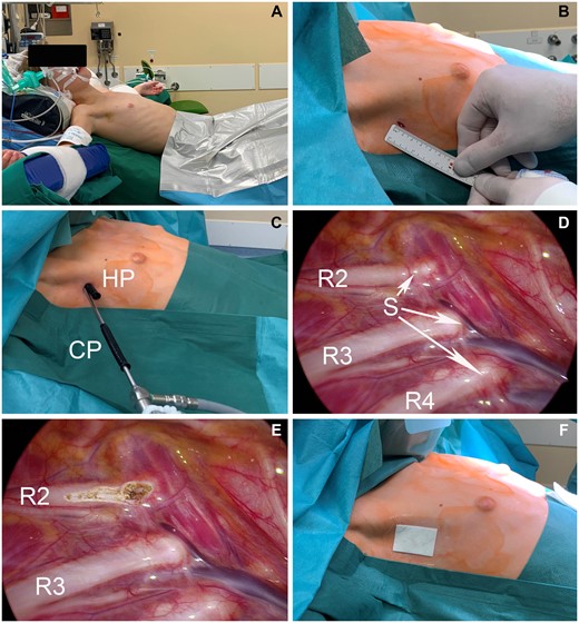 Surgical technique of staged single-port thoracoscopic R2 sympathicotomy for facial blushing. (A) Patient positioned in the beach-chair position or semi-Fowler position, seated at a 45° angle, with both arms spread out. (B) Marked incision just posterior to the axillary/mammary fold. (C) The positioning of the camera port and the cautery hook port through the same incision. (D) Thoracoscopic view of the right superior mediastinum with identification of the sympathetic nerve running along the neck of the ribs (R2–R4). (E) Thoracoscopic view after R2 sympathicotomy. (F) Double plastic-coated sticker placed over the incision site to prevent air re-entry. CP: camera port; HP: hook port; S: sympathetic nerve.