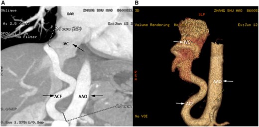 Computed tomography angiography showing a tortuous, large, and very long fistula between the abdominal aorta and inferior vena cava. IVC: Inferior vena cava; AAO: Abdominal aorta; ACF: Aortocaval fistula.