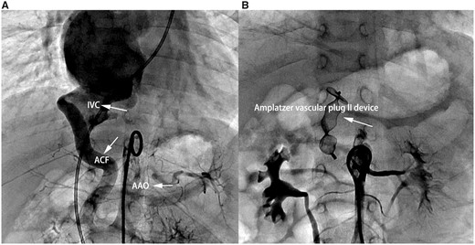 Aortography showing the distal aortocaval fistula distal. (A) Notice the dilatation of the inferior vena cava. (B) Aortography showing complete occlusion of the fistula with a 12-mm Amplatzer vascular plug II device.IVC: Inferior vena cava; AAO: Abdominal aorta; ACF: Aortocaval fistula.