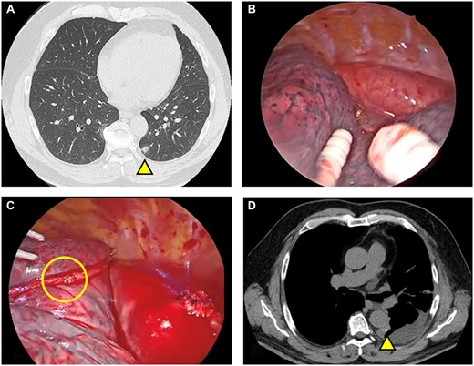 Preoperative and postoperative chest computed tomography and intraoperative findings. (A) Computed tomography revealed a lung nodule in the lower lobe of the left lung (yellow triangle). (B) Intraoperative findings of the first operation: No instrument-related injury to the aorta was found. (C) Intraoperative findings from the second operation comprised a wedge resection and the sutured aorta. The formation of an incomplete beta loop and damaged staples were not found on the stapling line, though a few staples on the stapling line were intertwined. (D) Postoperative chest computed tomography: The staple line contacts the aorta longitudinally.