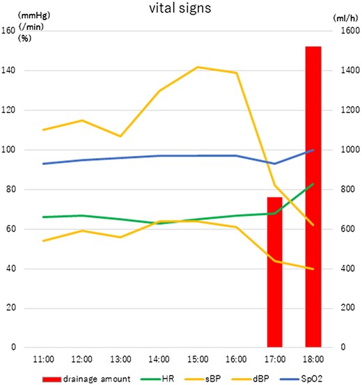 Postoperative vital signs while the patient was in the intensive care unit. The patient's vital signs remained stable for 6 h postoperatively. Then, suddenly, fresh blood appeared in the fluid drained from the wound and his blood pressure dropped. HR: heart rate; dBP: diastolic blood pressure; sBP: systolic blood pressure; SpO2: oxygen nadir.